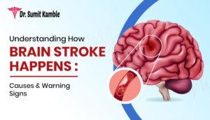 How Brain Stroke Happens